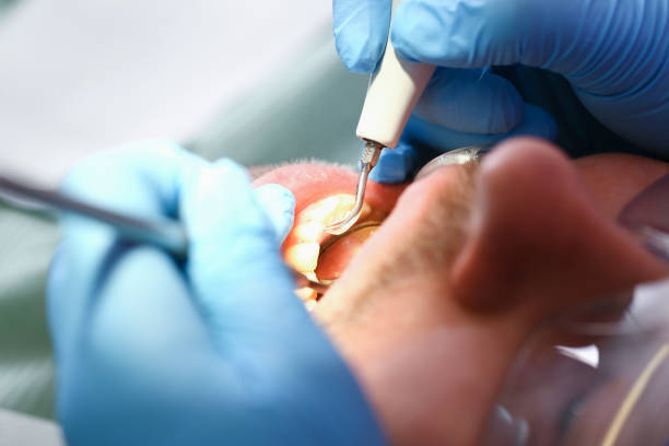 Best Emergency Root Canal Treatment in Ada, OK
