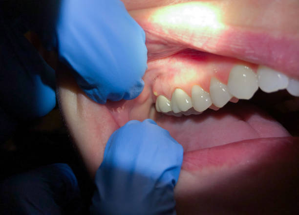 Best Emergency Tooth Extraction in Ada, OK